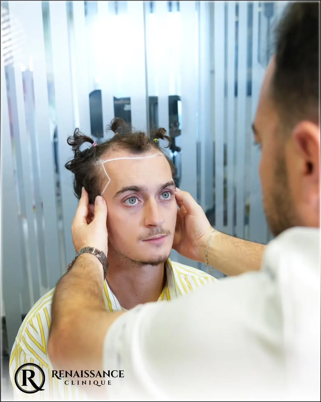 Médecin dessinant la ligne frontale sur le front d’un jeune patient lors d’une consultation capillaire personnalisée chez Renaissance Clinique.