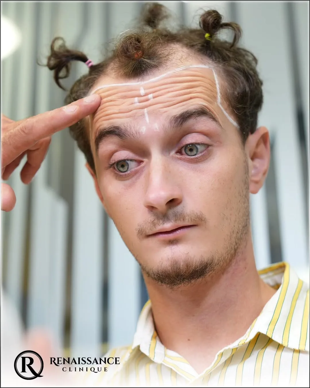 Jeune patient examinant les marques tracées sur son front pour définir la future ligne capillaire avant une greffe de cheveux, lors d’une consultation à Renaissance Clinique.