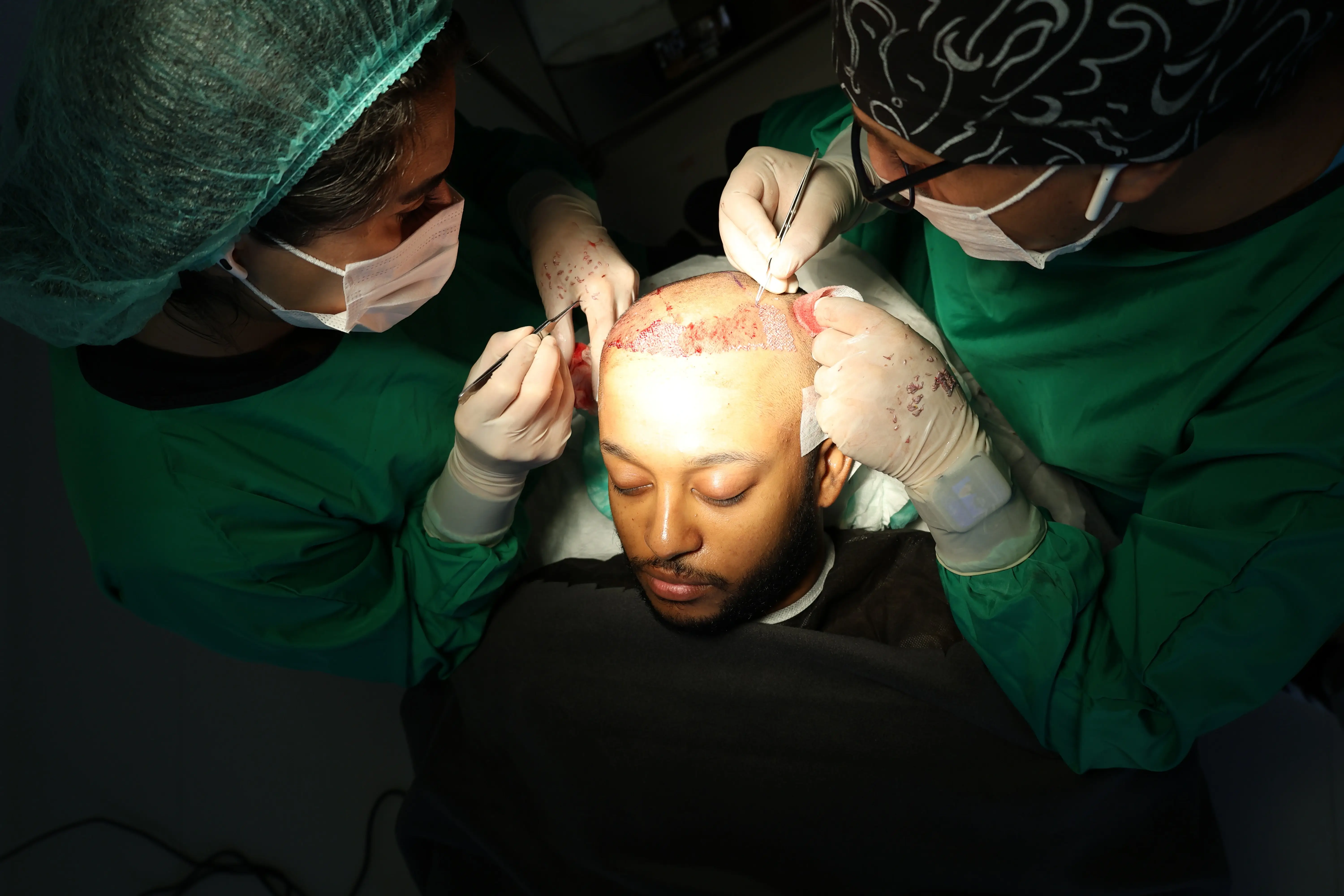 Chirurgiens créant des micro-incisions avec lame en saphir lors d’une greffe de cheveux FUE, pour une implantation précise et une cicatrisation optimisée.